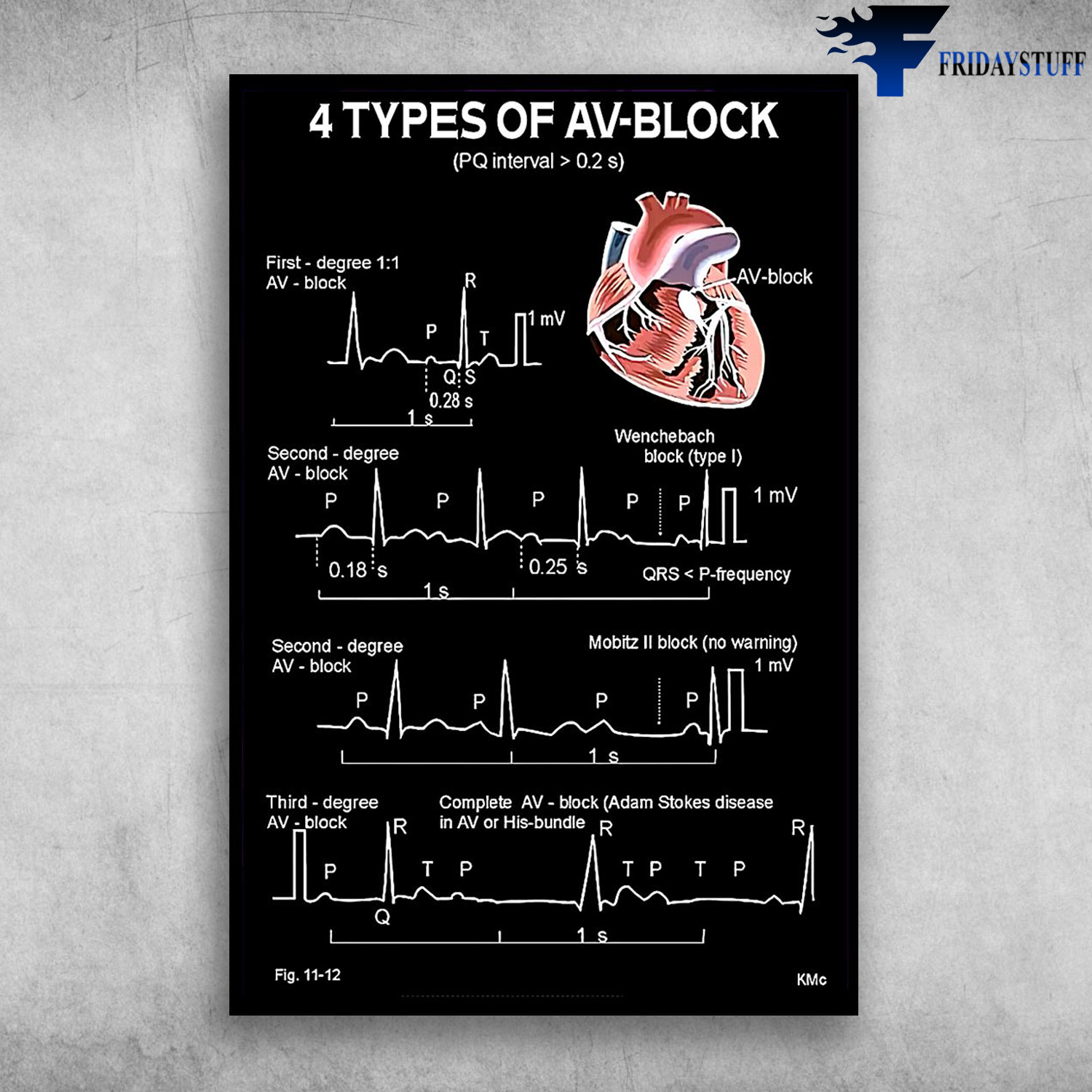 Four Types Of Av Block Heart Beat Human Heart Anatomy