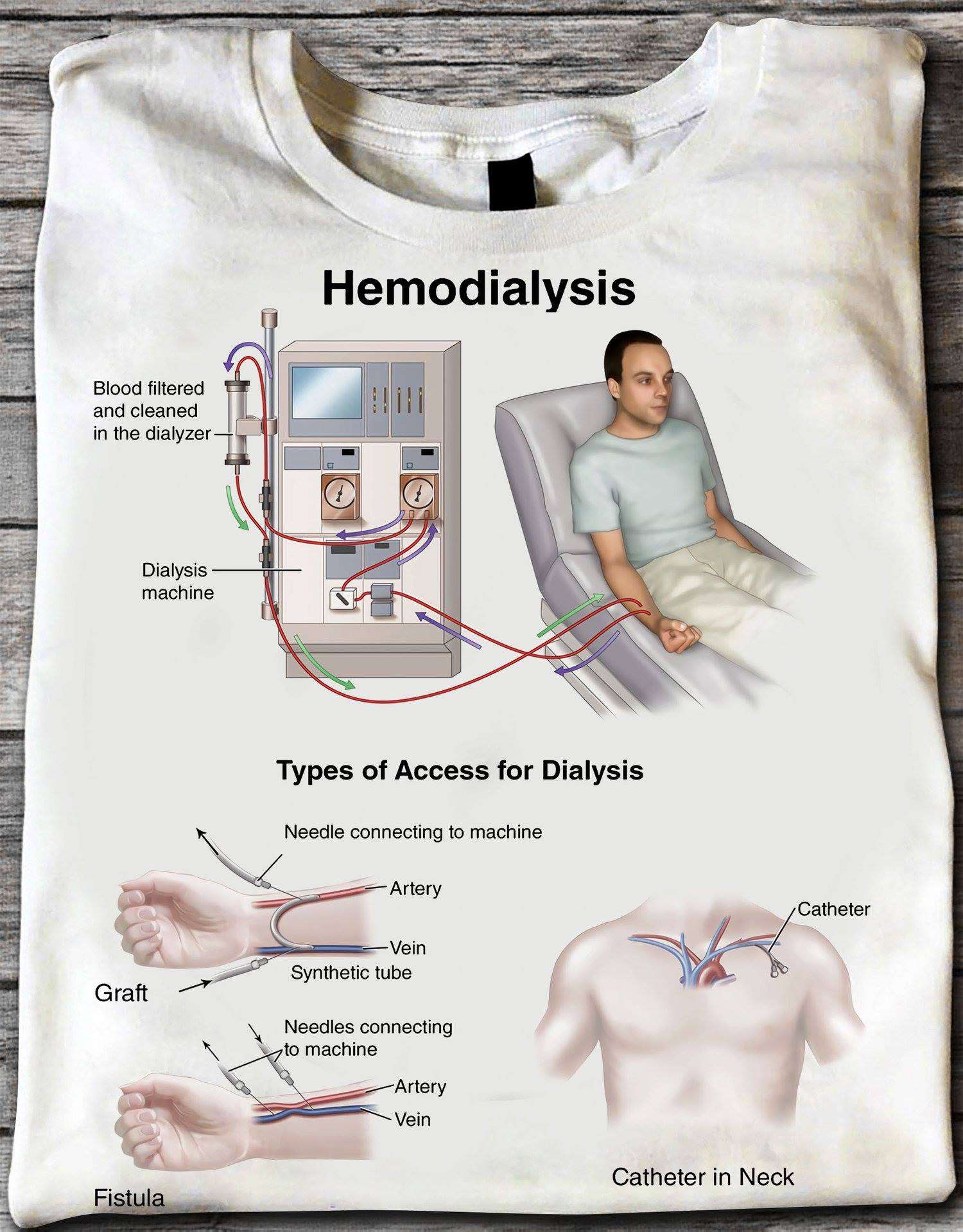 hemodialysis Blood filtered and cleaned in the dialyzer dialysis machine