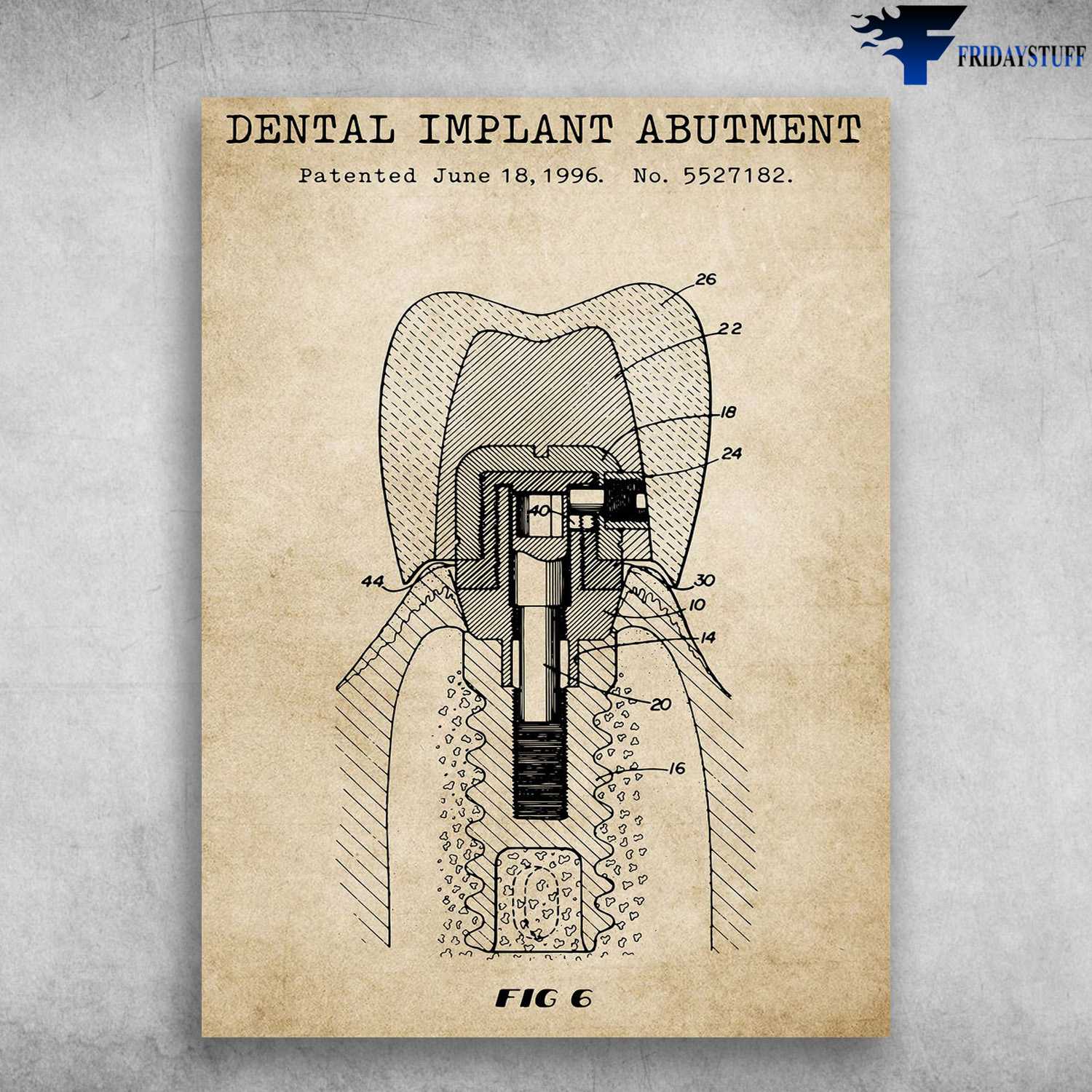 Dentist Room, Dentist Poster - Dental Implant Abutment