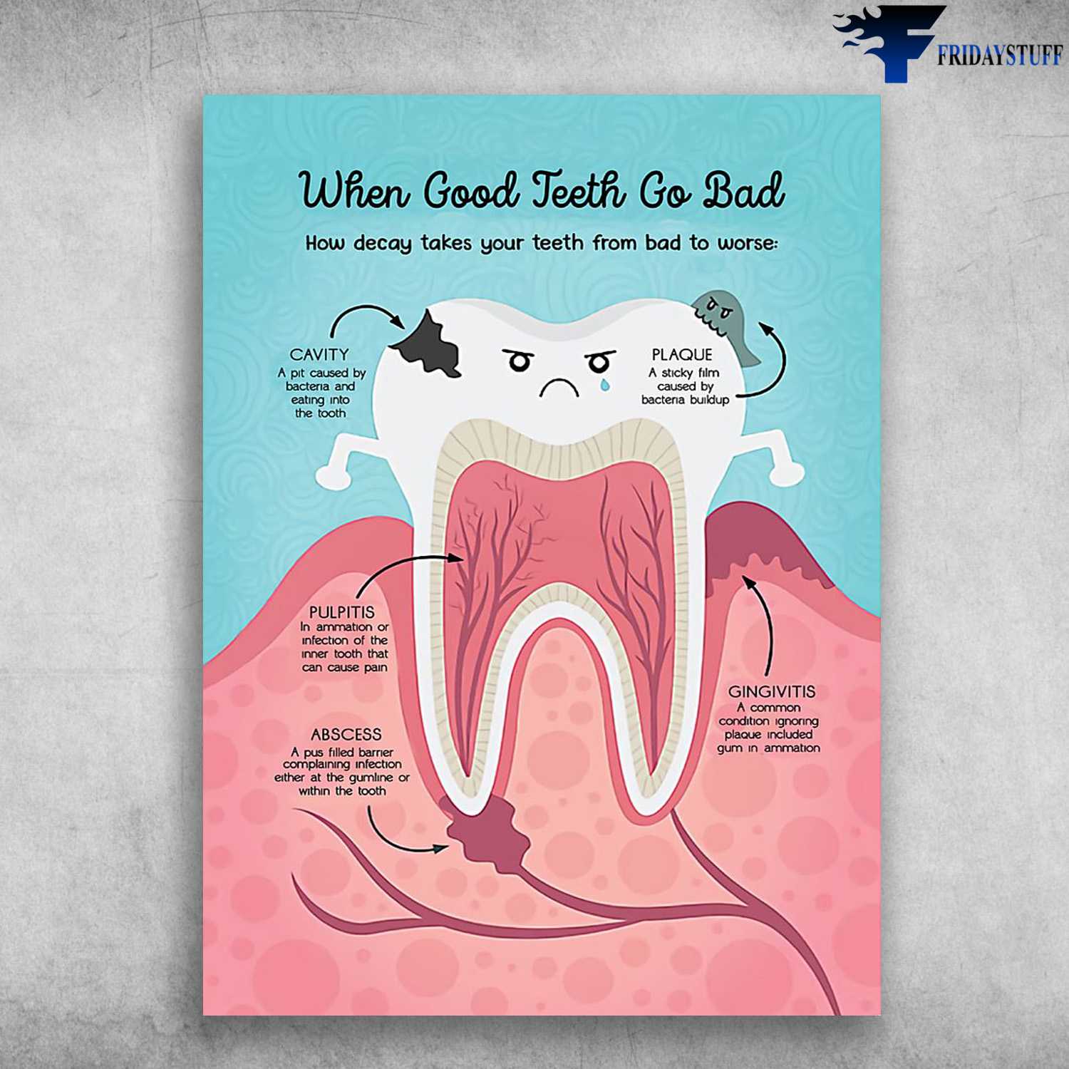 Teeth Care, Dentist Poster - When Good Teeth Go Bad, How Decay Takes From Bad To Worse, Cavity , Plaque, Pulptis, Abscess, Gingivitis